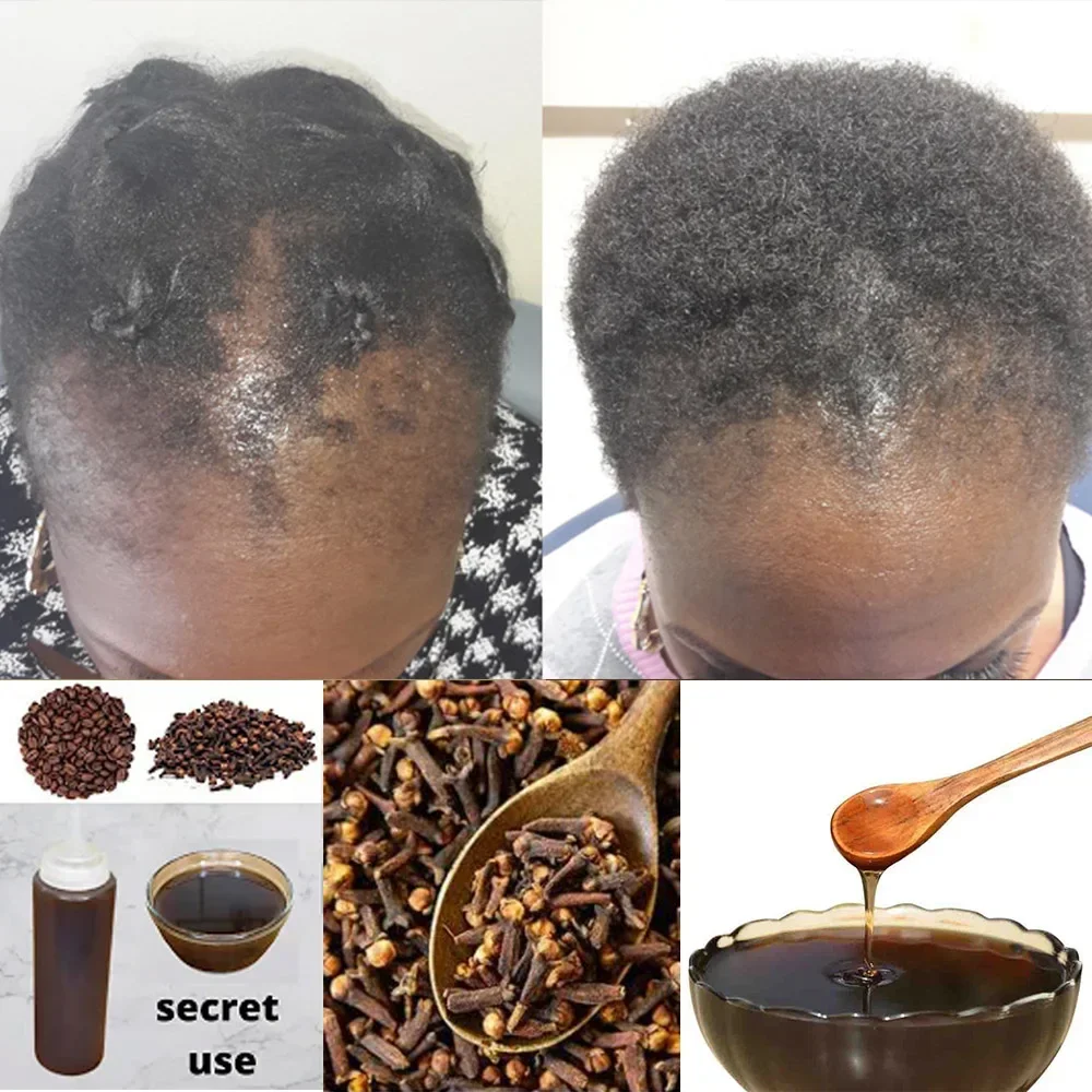 Hair Care Ginseng - Africa Women Traction Alopecia Treatment Hair