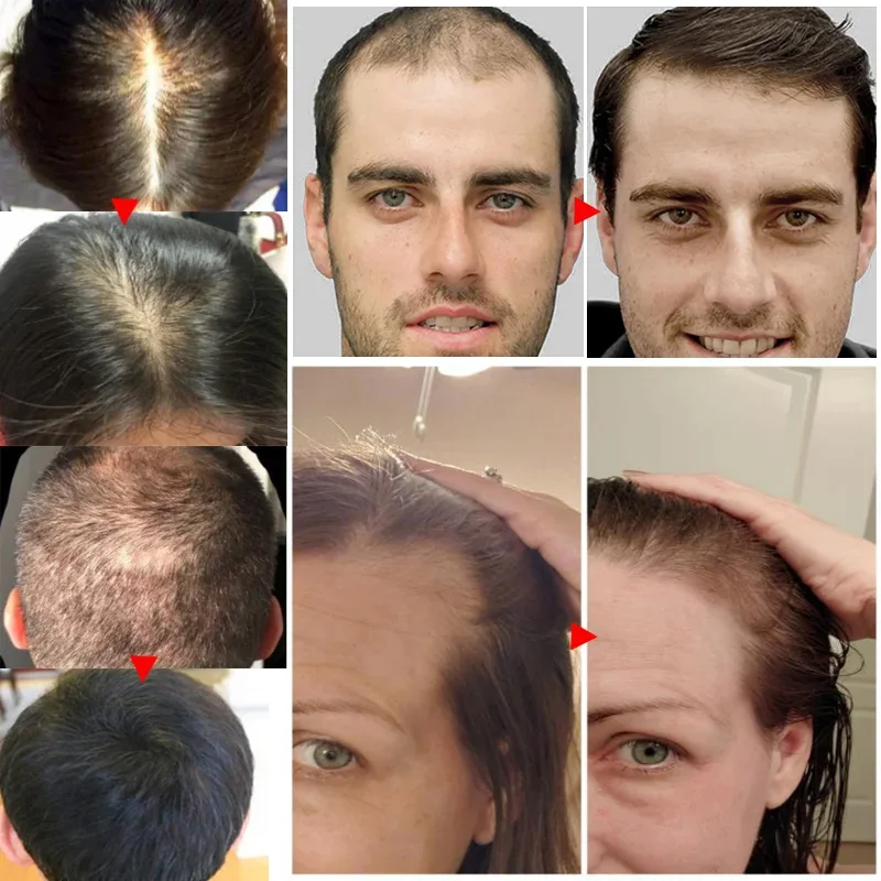 Ginger Hair Growth Essential O - Hair Care Essential Oil Atomizing recension och pris