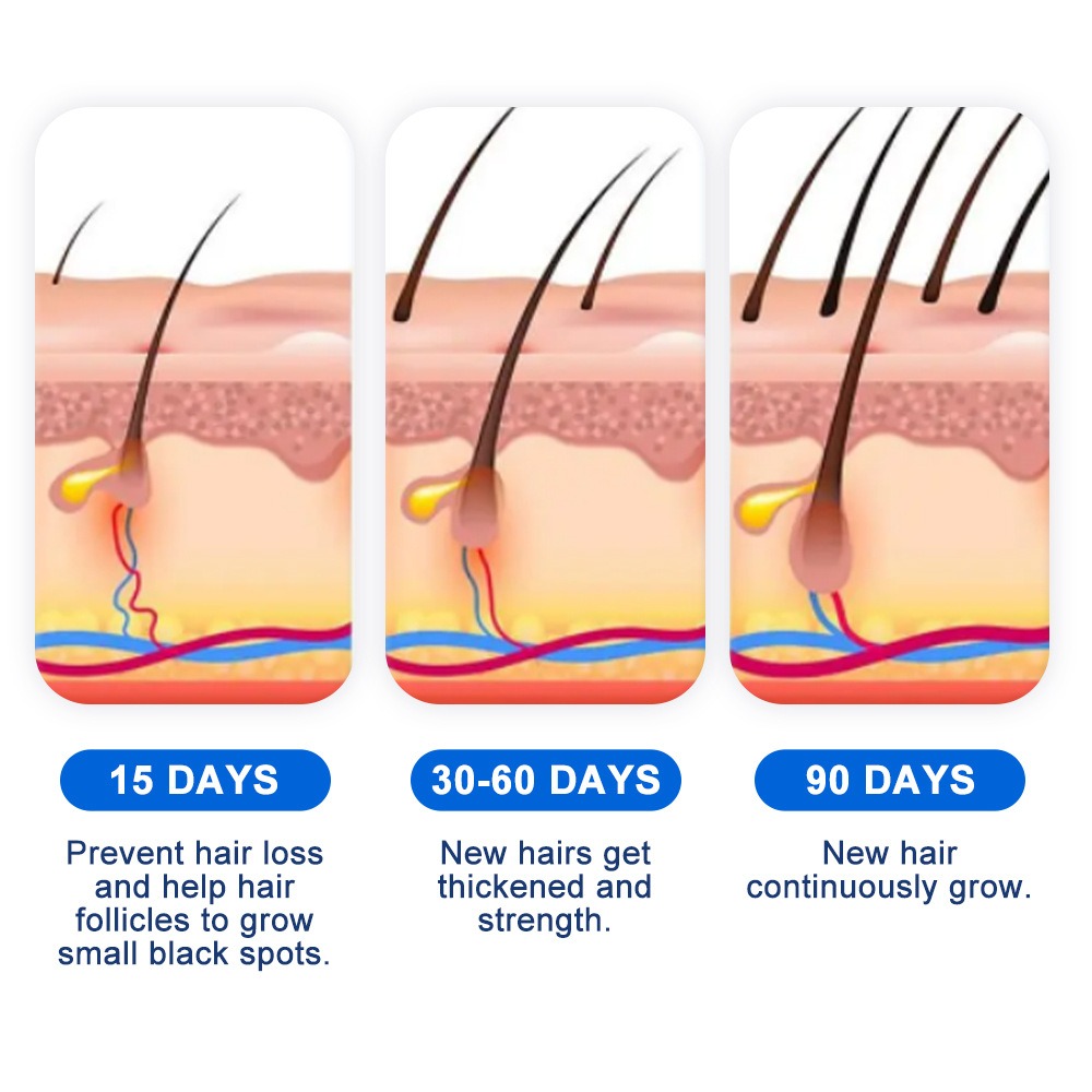 Alopecia Hair Growth Spray Sop - Hair Care Growth recension och pris