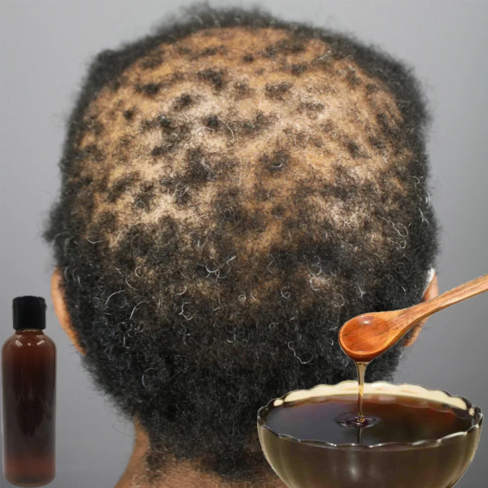 Africa Women Traction Alopecia - Hair Care Ginseng recension och pris