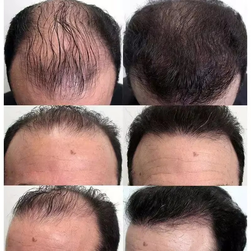 Fast Hair Growth Serum Hair Re - Hair Care Essential Oil Atomizing recension och pris
